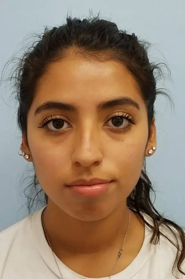 Rhinoplasty — before, front — Dr. Faramarz Shabdiz, MD. Individual results vary.