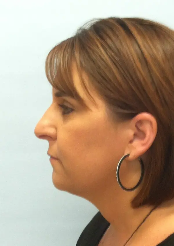 Rhinoplasty — before, left profile — Dr. Faramarz Shabdiz, MD. Individual results vary.