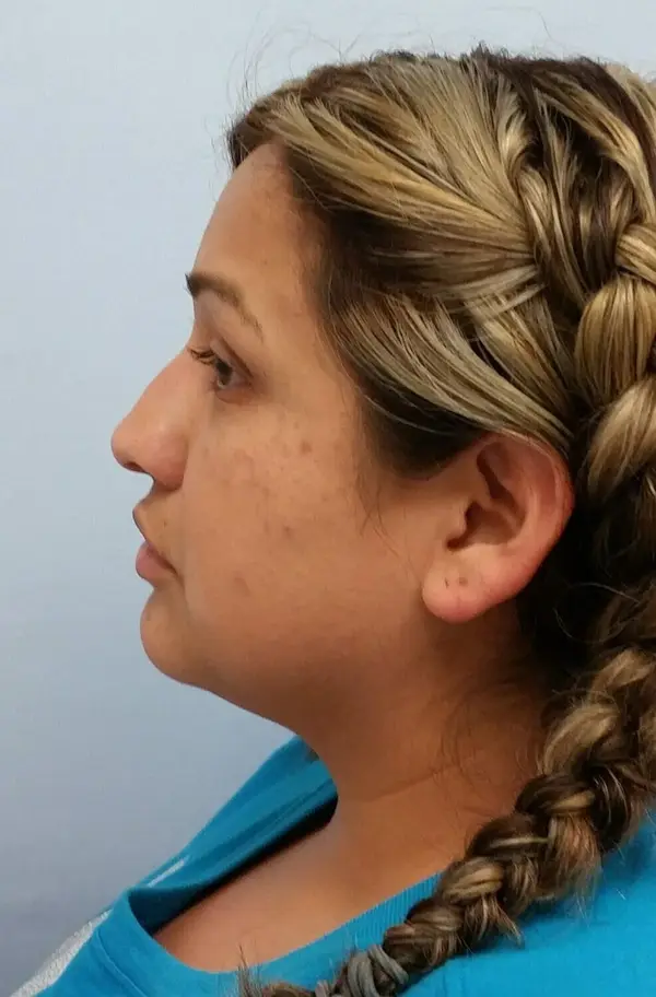 Rhinoplasty — before, left profile — Dr. Faramarz Shabdiz, MD. Individual results vary.