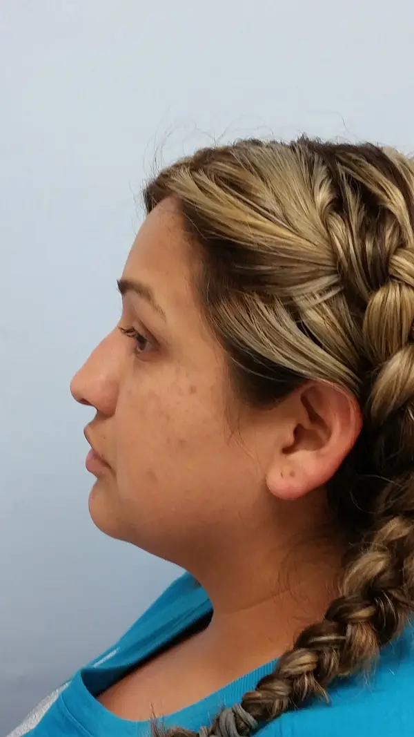 Rhinoplasty — before photo, left profile, Dr. Faramarz Shabdiz, MD, Orange County, CA. Individual results vary.
