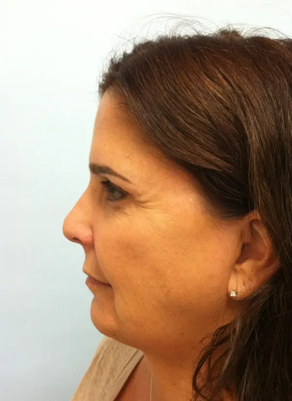 Rhinoplasty — before, left profile — Dr. Faramarz Shabdiz, MD. Individual results vary.