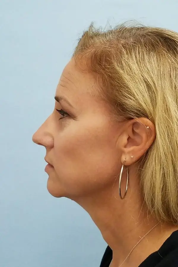 Rhinoplasty — before, left profile — Dr. Faramarz Shabdiz, MD. Individual results vary.