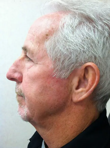 Rhinoplasty — before, left profile — Dr. Faramarz Shabdiz, MD. Individual results vary.