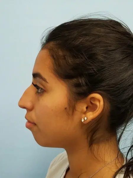Rhinoplasty — before, left profile — Dr. Faramarz Shabdiz, MD. Individual results vary.