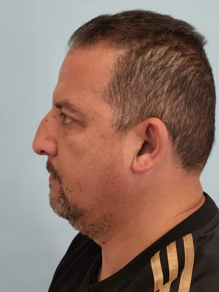 Rhinoplasty — before, left profile — Dr. Faramarz Shabdiz, MD. Individual results vary.