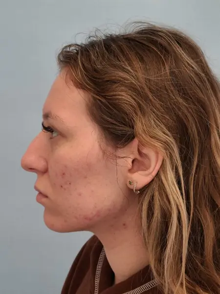 Rhinoplasty — before, left profile — Dr. Faramarz Shabdiz, MD. Individual results vary.