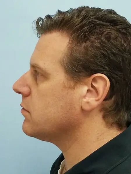 Rhinoplasty — before, left profile — Dr. Faramarz Shabdiz, MD. Individual results vary.