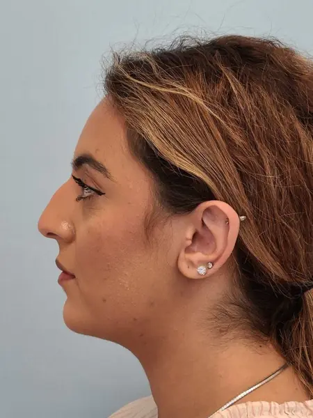 Rhinoplasty — before, left profile — Dr. Faramarz Shabdiz, MD. Individual results vary.