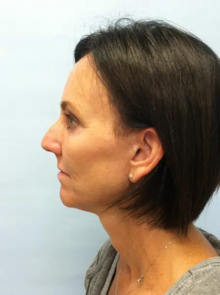 Rhinoplasty — before, left profile — Dr. Faramarz Shabdiz, MD. Individual results vary.
