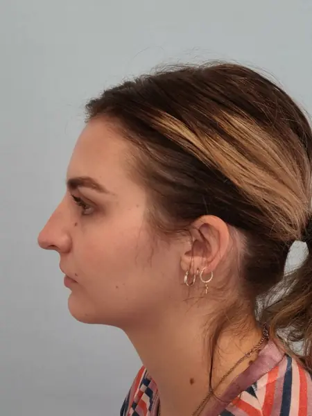 Rhinoplasty — before, left profile — Dr. Faramarz Shabdiz, MD. Individual results vary.