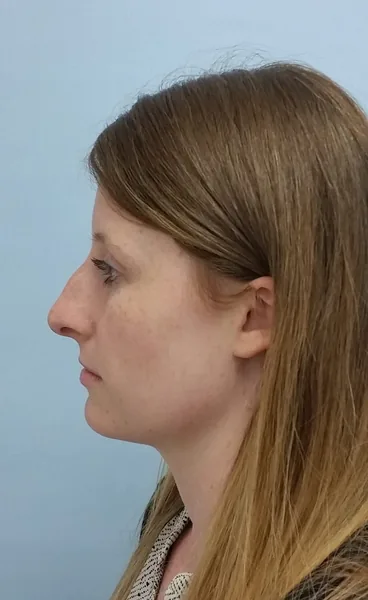 Additional Results — before photo, left profile, Dr. Faramarz Shabdiz, MD, Orange County, CA. Individual results vary.