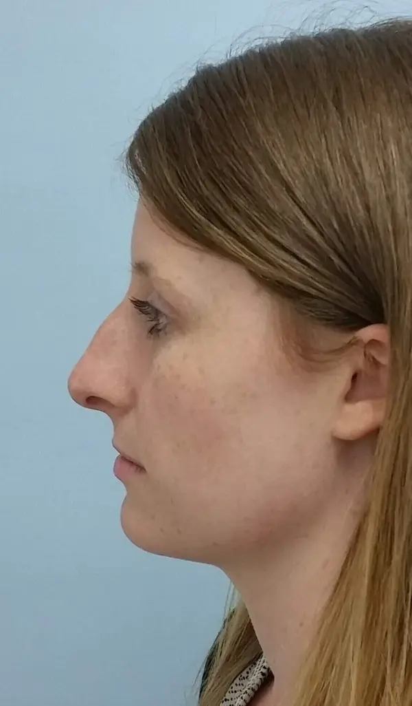 Rhinoplasty — before, left profile — Dr. Faramarz Shabdiz, MD. Individual results vary.