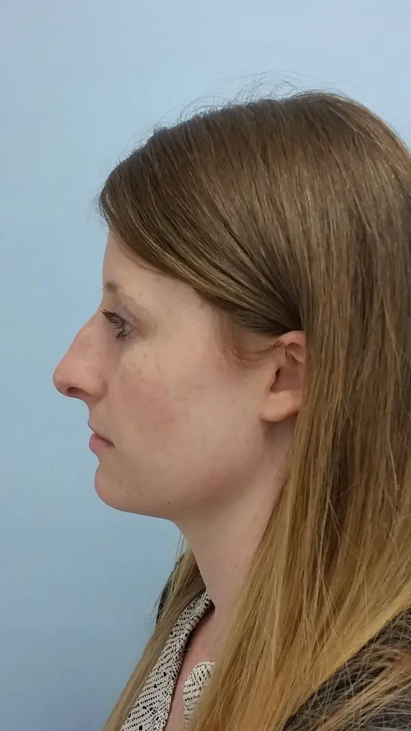 Rhinoplasty — before photo, left profile, Dr. Faramarz Shabdiz, MD, Orange County, CA. Individual results vary.