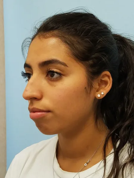 Additional Results — before photo, oblique view, Dr. Faramarz Shabdiz, MD, Orange County, CA. Individual results vary.