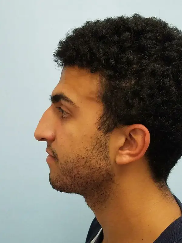 Rhinoplasty — before, left profile — Dr. Faramarz Shabdiz, MD. Individual results vary.