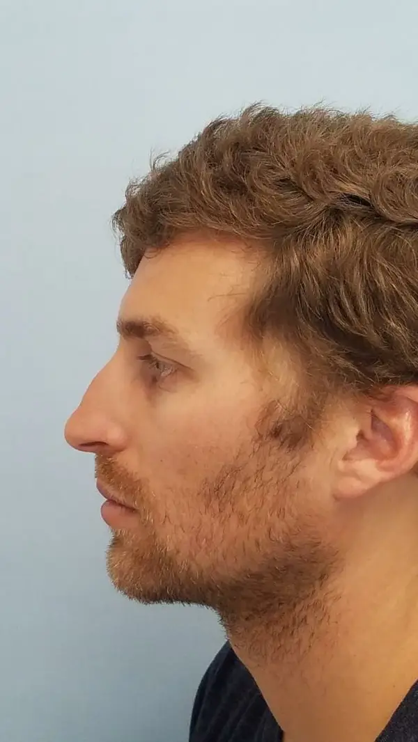 Rhinoplasty — before, left profile — Dr. Faramarz Shabdiz, MD. Individual results vary.