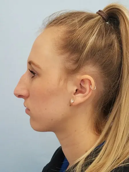 Rhinoplasty — before, left profile — Dr. Faramarz Shabdiz, MD. Individual results vary.