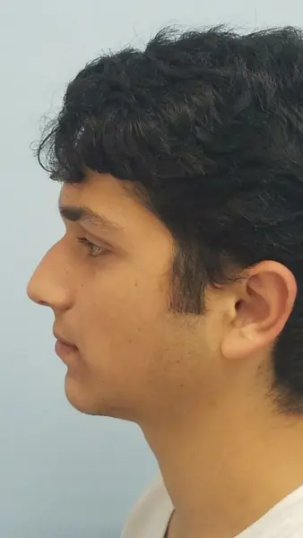 Rhinoplasty — before, left profile — Dr. Faramarz Shabdiz, MD. Individual results vary.