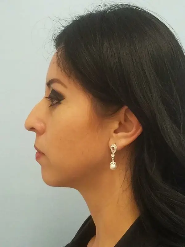 Rhinoplasty — before, left profile — Dr. Faramarz Shabdiz, MD. Individual results vary.