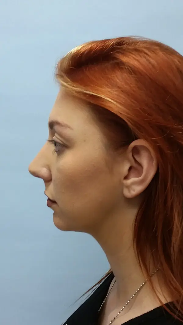 Rhinoplasty — before, left profile — Dr. Faramarz Shabdiz, MD. Individual results vary.