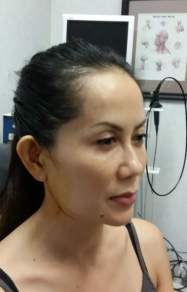 Otoplasty (ear surgery) — before, oblique view — Dr. Faramarz Shabdiz, MD. Individual results vary.