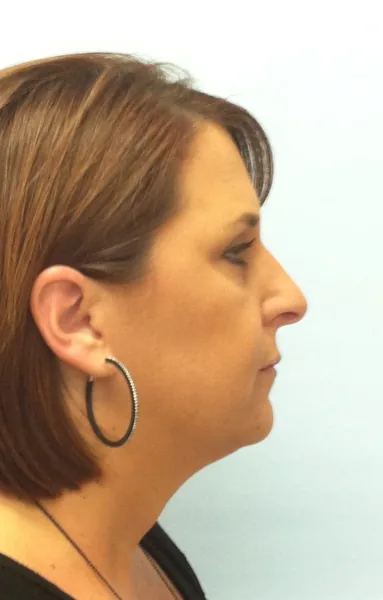 Additional Results — before photo, right profile, Dr. Faramarz Shabdiz, MD, Orange County, CA. Individual results vary.