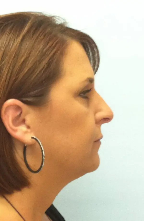 Rhinoplasty — before, right profile — Dr. Faramarz Shabdiz, MD. Individual results vary.