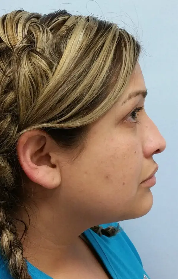 Rhinoplasty — before, right profile — Dr. Faramarz Shabdiz, MD. Individual results vary.