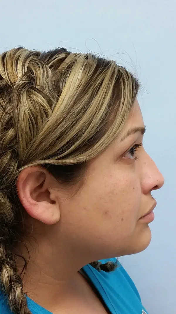 Rhinoplasty — before photo, right profile, Dr. Faramarz Shabdiz, MD, Orange County, CA. Individual results vary.