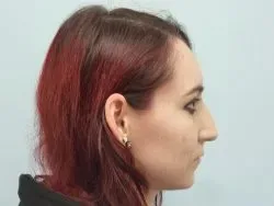 Additional Results — before photo, right profile, Dr. Faramarz Shabdiz, MD, Orange County, CA. Individual results vary.
