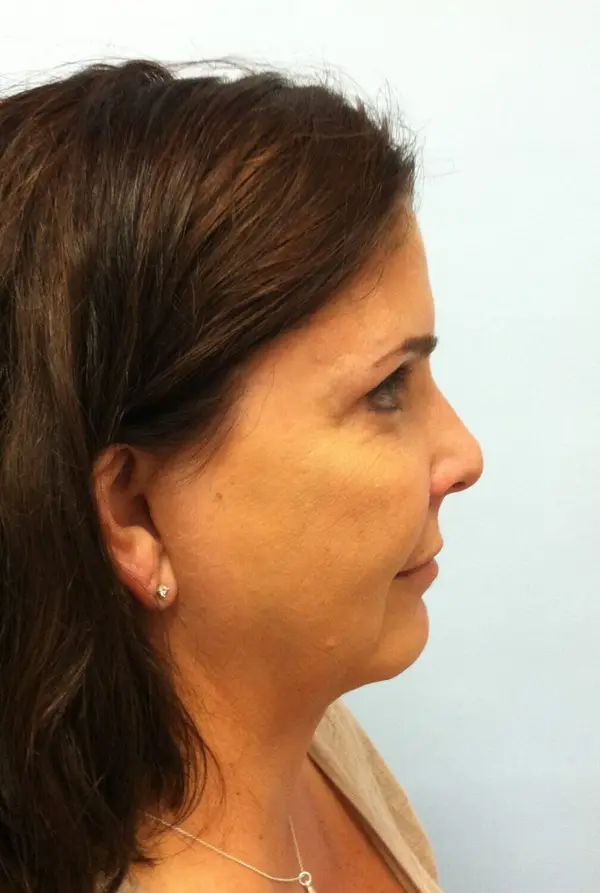 Rhinoplasty — before, right profile — Dr. Faramarz Shabdiz, MD. Individual results vary.