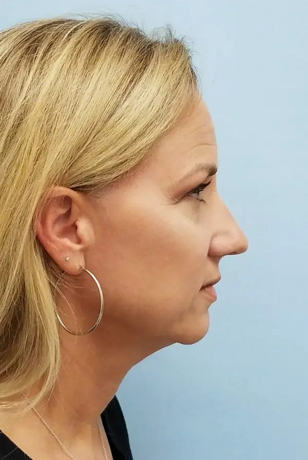 Rhinoplasty — before, right profile — Dr. Faramarz Shabdiz, MD. Individual results vary.