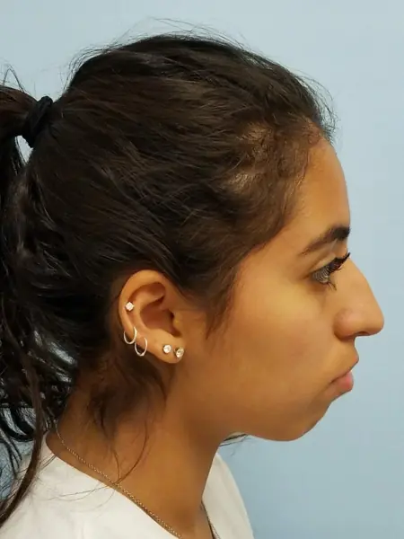 Rhinoplasty — before, right profile — Dr. Faramarz Shabdiz, MD. Individual results vary.
