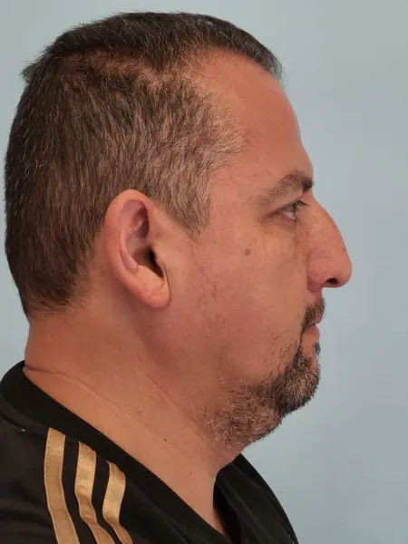 Rhinoplasty — before, right profile — Dr. Faramarz Shabdiz, MD. Individual results vary.