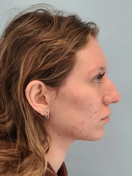 Rhinoplasty — before, right profile — Dr. Faramarz Shabdiz, MD. Individual results vary.