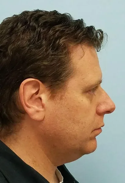 Rhinoplasty — before, right profile — Dr. Faramarz Shabdiz, MD. Individual results vary.