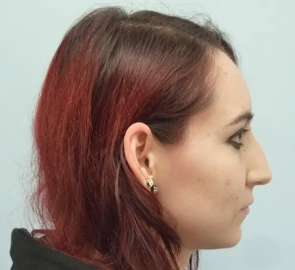 Rhinoplasty — before photo, right profile, Dr. Faramarz Shabdiz, MD, Orange County, CA. Individual results vary.