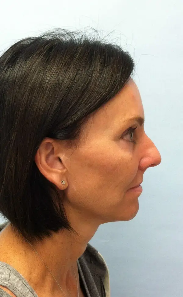 Rhinoplasty — before, right profile — Dr. Faramarz Shabdiz, MD. Individual results vary.