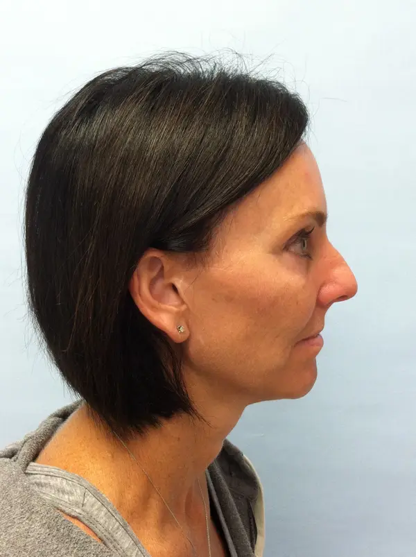 Rhinoplasty — before photo, right profile, Dr. Faramarz Shabdiz, MD, Orange County, CA. Individual results vary.