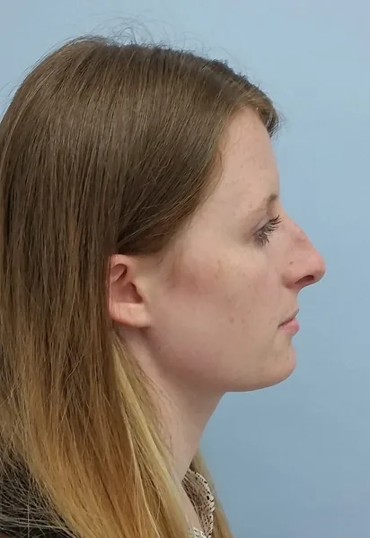 Additional Results — before photo, right profile, Dr. Faramarz Shabdiz, MD, Orange County, CA. Individual results vary.