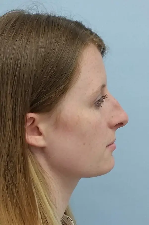 Rhinoplasty — before, right profile — Dr. Faramarz Shabdiz, MD. Individual results vary.