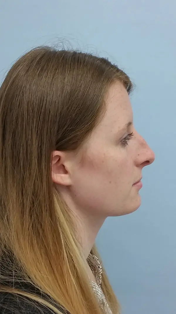 Rhinoplasty — before photo, right profile, Dr. Faramarz Shabdiz, MD, Orange County, CA. Individual results vary.