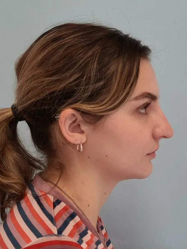 Rhinoplasty — before, right profile — Dr. Faramarz Shabdiz, MD. Individual results vary.