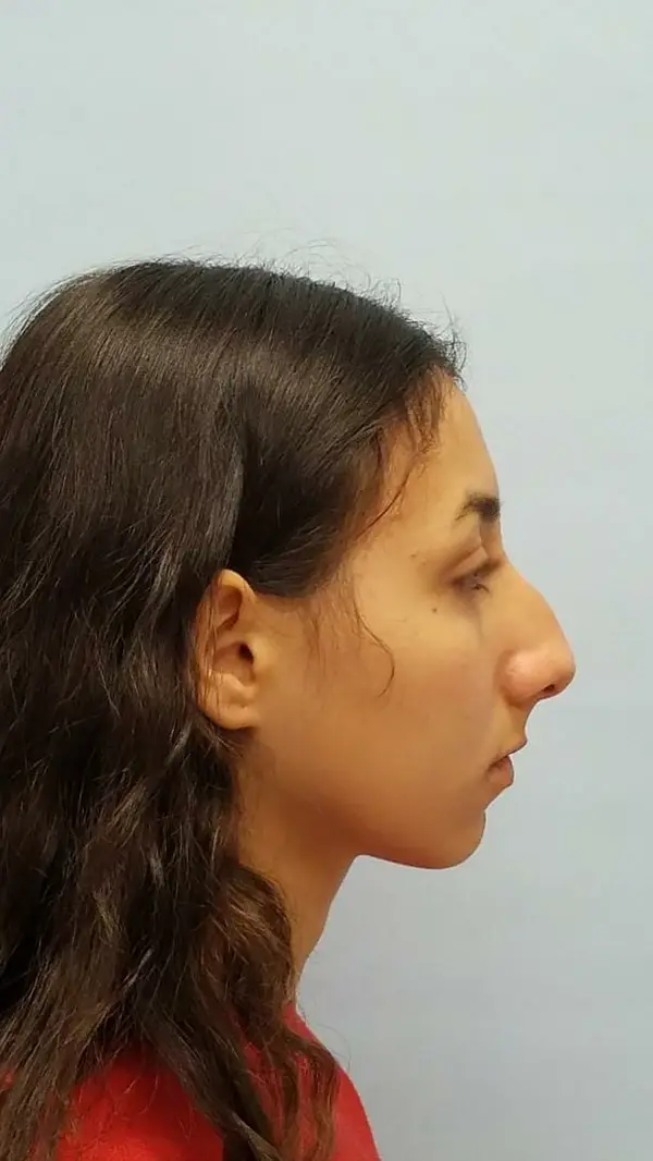 Rhinoplasty — before photo, right profile, Dr. Faramarz Shabdiz, MD, Orange County, CA. Individual results vary.