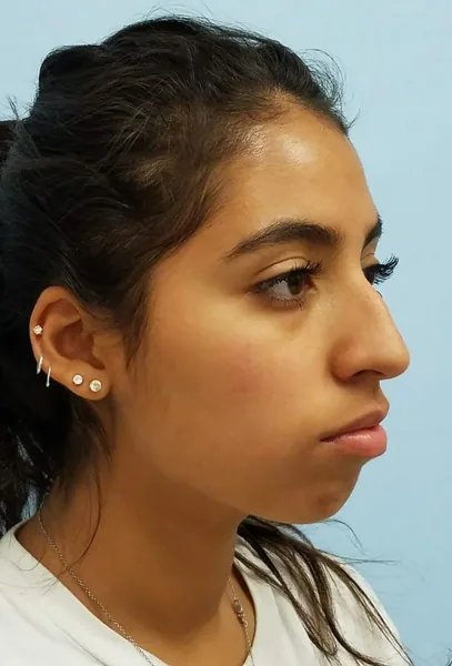 Additional Results — before photo, oblique view, Dr. Faramarz Shabdiz, MD, Orange County, CA. Individual results vary.