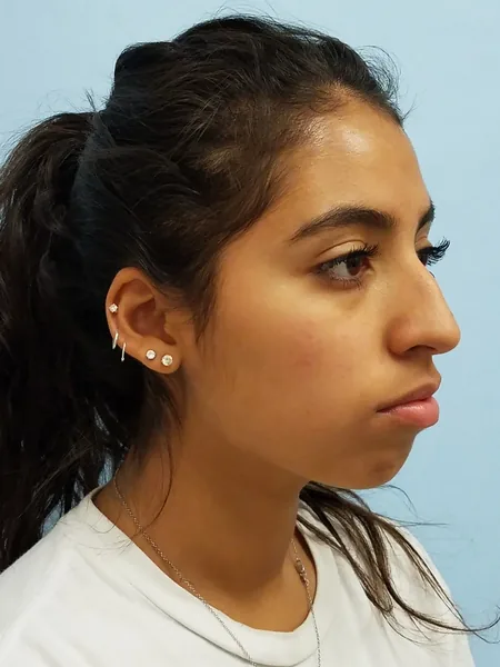 Additional Results — before photo, oblique view, Dr. Faramarz Shabdiz, MD, Orange County, CA. Individual results vary.