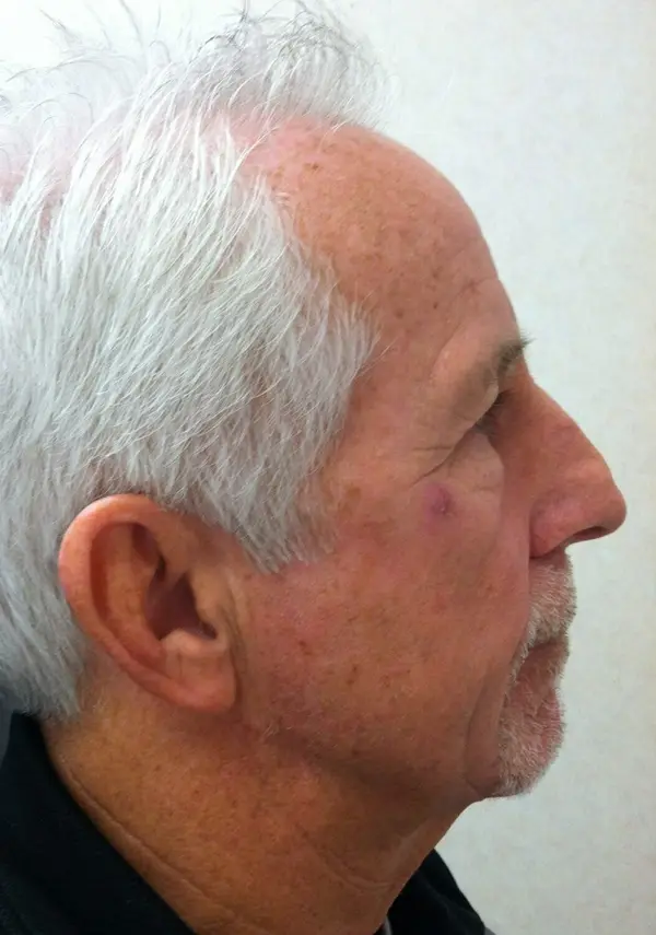 Rhinoplasty — before, right profile — Dr. Faramarz Shabdiz, MD. Individual results vary.