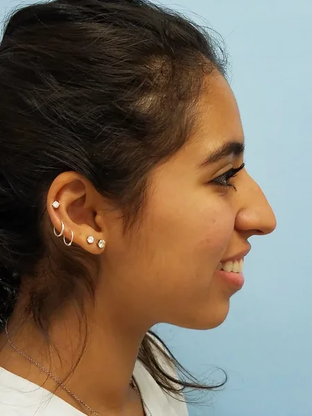 Additional Results — before photo, right profile, Dr. Faramarz Shabdiz, MD, Orange County, CA. Individual results vary.
