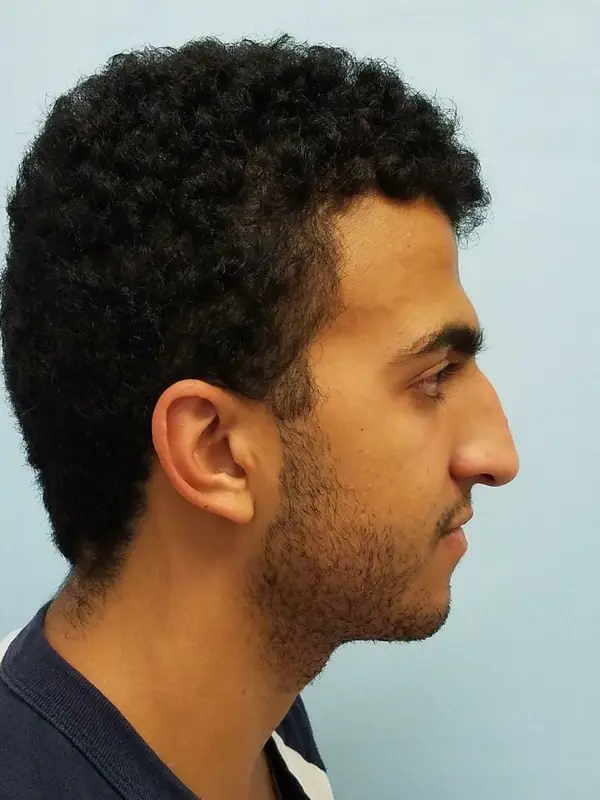 Rhinoplasty — before, right profile — Dr. Faramarz Shabdiz, MD. Individual results vary.
