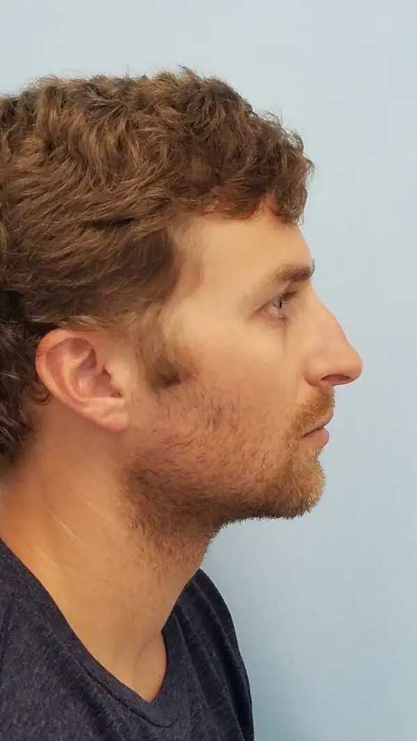 Rhinoplasty — before, right profile — Dr. Faramarz Shabdiz, MD. Individual results vary.